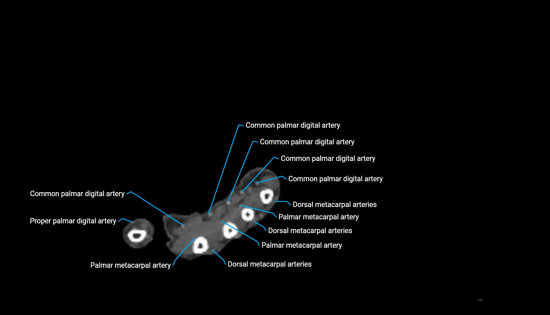 CTA upper limb axial cross sectional anatomy labelled image 54 (2).webp